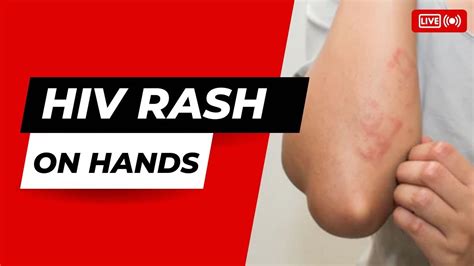 Hiv Rash Hands