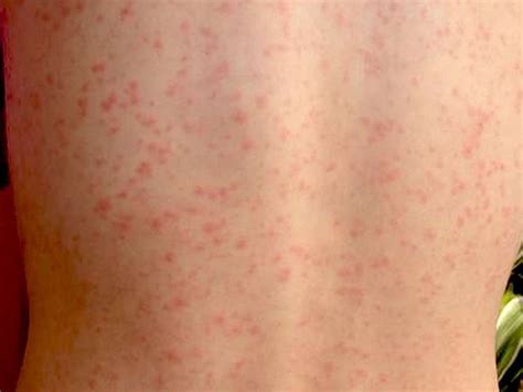 Scarlet fever: Causes, symptoms, treatment, and complications