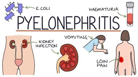 Symptoms of pyelonephritis - MEDizzy