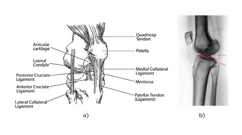 Hip Knee Hyperextension