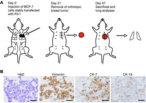 JCI - Deregulation of the Pit-1 transcription factor in human breast cancer cells promotes tumor ...