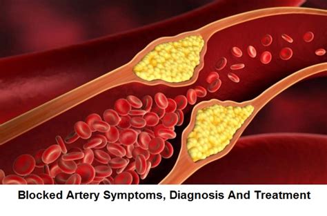 Blocked Artery Symptoms, Diagnosis And Treatment | Health And Beauty