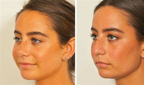 Rosacea & Bulbous Nose- Etiology & Treatment… – Juvenas.com