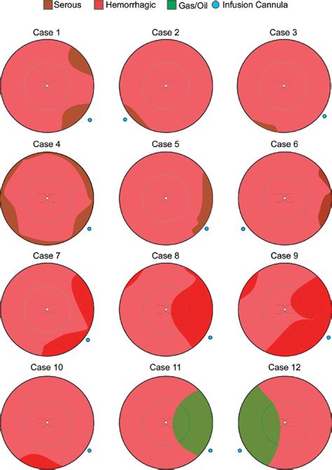 Choroidal detachment maps. Fundus diagrams of intraoperative choroidal... | Download Scientific ...