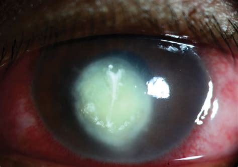 Fungal Corneal Ulcer