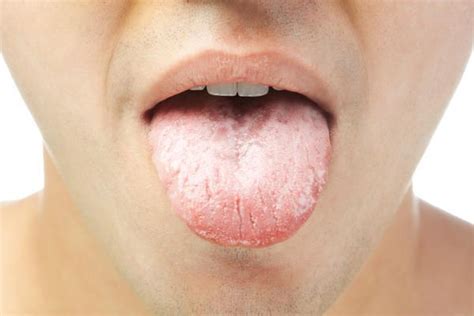 Home Remedies For White Coated Tongue (Get Your Tongue Pink Again) in ...