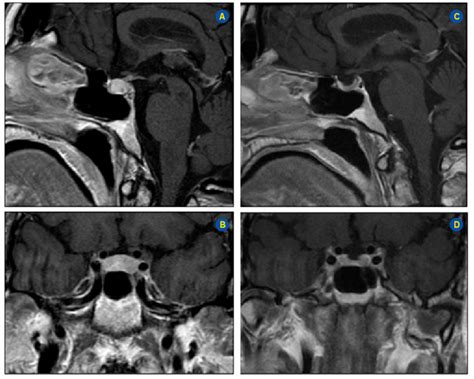 -Pituitary MRI scans at diagnosis of ipilimumab-induced autoimmune... | Download Scientific Diagram