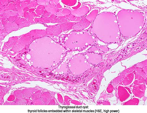 Pathology Outlines - Thyroglossal duct cyst