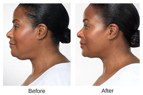 Kybella® – Double Chin Reduction | Board Certified Dermatologists ...