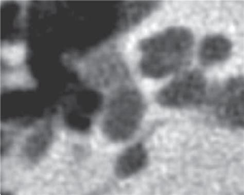 CT, axial cut, showing an isolated fenestral otosclerosis ...