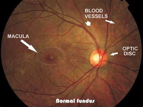 Fundus examination