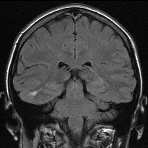 Focal cortical dysplasia | Radiology Case | Radiopaedia.org