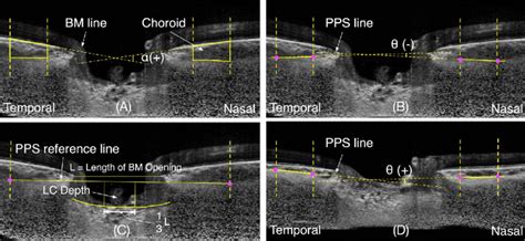 Illustration of measurement of Bruch's membrane angle and of the ...