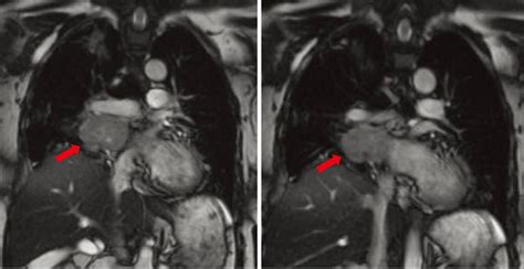 Paraganglioma Tumor Causes, Symptoms, Diagnosis, Treatment