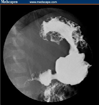 Radiation Exposure: Upper Gi Series Radiation Exposure