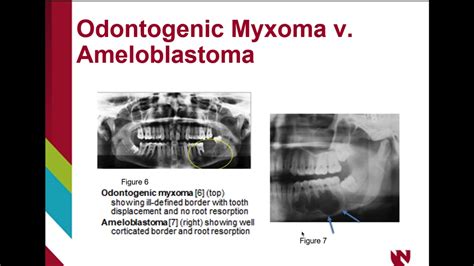 Odontogenic myxoma - YouTube