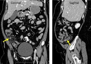 Acute appendicitis: transverse retrocaecal appendix – Radiology Cases