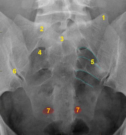 Sacral Foramina Xray