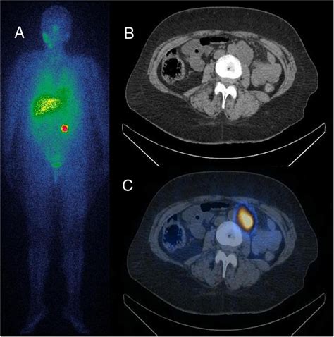 Coronal 24 h-123 I-MIBG (A) scan showing a focal uptake in the left... | Download Scientific Diagram