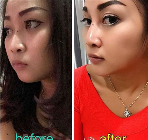 Nose Bridge Augmentation Surgery Before After » Rhinoplasty: Cost, Pics, Reviews, Q&A