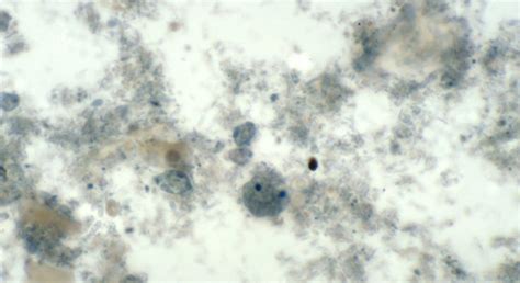 Dientamoeba fragilis: Symptoms, Testing and Natural Treatment - Byron ...