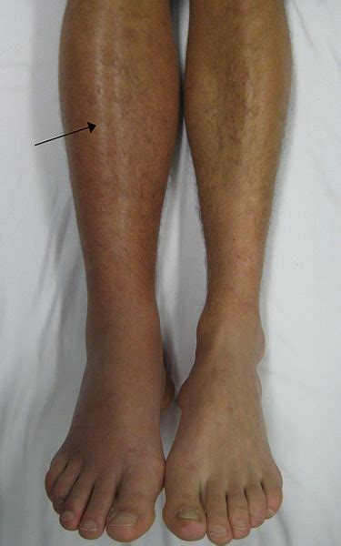 Symptoms of Blood Clot in Leg • MyHeart