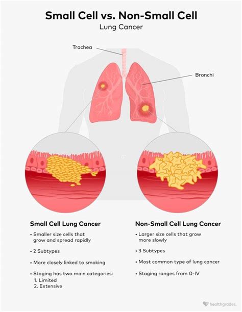 SCLC vs. NSCLC: Differences and Similarities