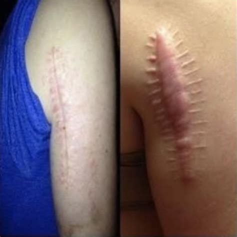 Skin Cancer Scars Images | SkinCancer.net