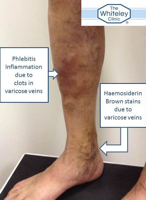 Prof. Mark S Whiteley: Phlebitis and haemosiderin from untreated varicose veins