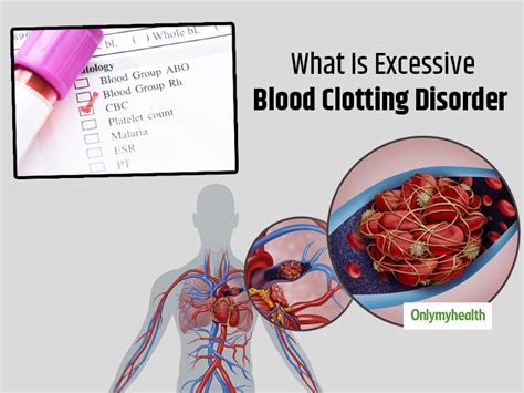 What Is Excessive Blood Clotting Disorder? Here Are Its Causes, Signs ...