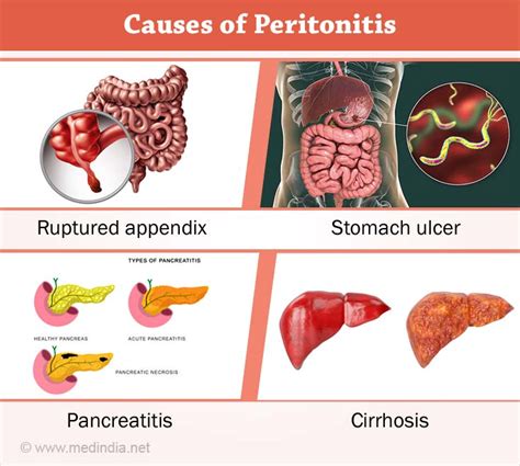 Peritonitis - Causes, Symptoms, Complications, Diagnosis, Treatment, Prevention