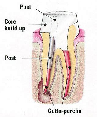 Post and Core – Medellin Dental SolutionsPost and Core - Medellin Dental Solutions