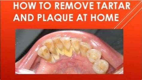 How to remove plaque and tartar at home?