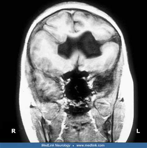 Schizencephaly | MedLink Neurology