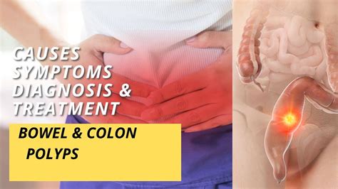 Bowel & Colon Polyps - Symptoms, Diagnosis and Treatment - YouTube