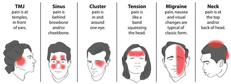 Trigger Point Therapy - Treating Tension Headaches (Part 3) | Trigger point therapy, Tension ...