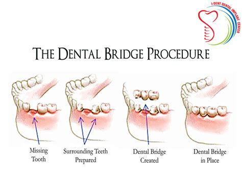 Dental Bridge Procedure