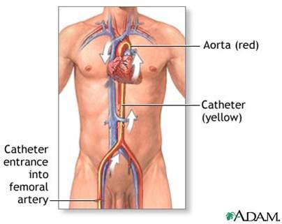 PETI AIS BURUK: Femoral Line Insertion