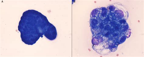 Mesothelial cells versus carcinoma in a fluid – eClinpath