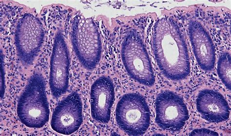 Chapter 20 – Microscopic Colitis | Abdominal Key