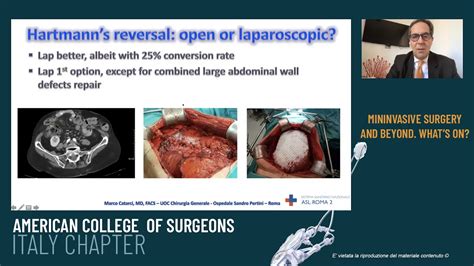 HARTMANN’S REVERSAL: OPEN OR LAPAROSCOPIC? | General Surgery Update