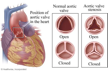 Aortic Stenosis