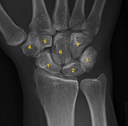 Carpal bones | Radiology Reference Article | Radiopaedia.org