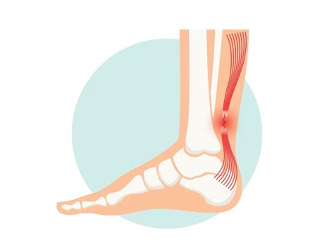 Achilles tendon rupture anatomical poster. Ankle injury, ligament ...