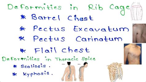 Chest Wall Deformities |Scoliosis|Barrel Chest |Pegion and funnel Chest || Medical Minion ...