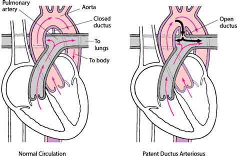 Patent Ductus Arteriosus - Children's Health Issues - MSD Manual Consumer Version