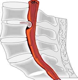 Lumbar Disc Herniation - Brain and Spine Center