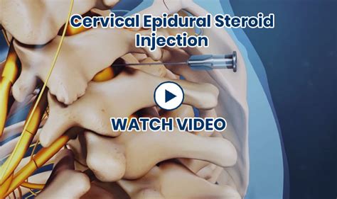 Epidural Steroid Injections – Dr. Robert Ycaza – Bradenton Pain ...