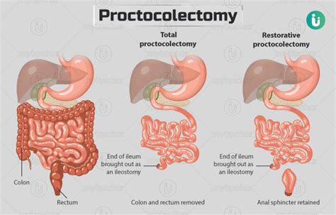 प्रोक्टोकोलेक्टॉमी क्या है, क्यों की जाती है, कैसे होती है, खर्च और ...