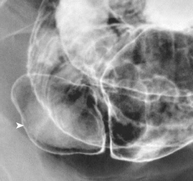 Computed Tomography Enteroclysis | Radiology Key